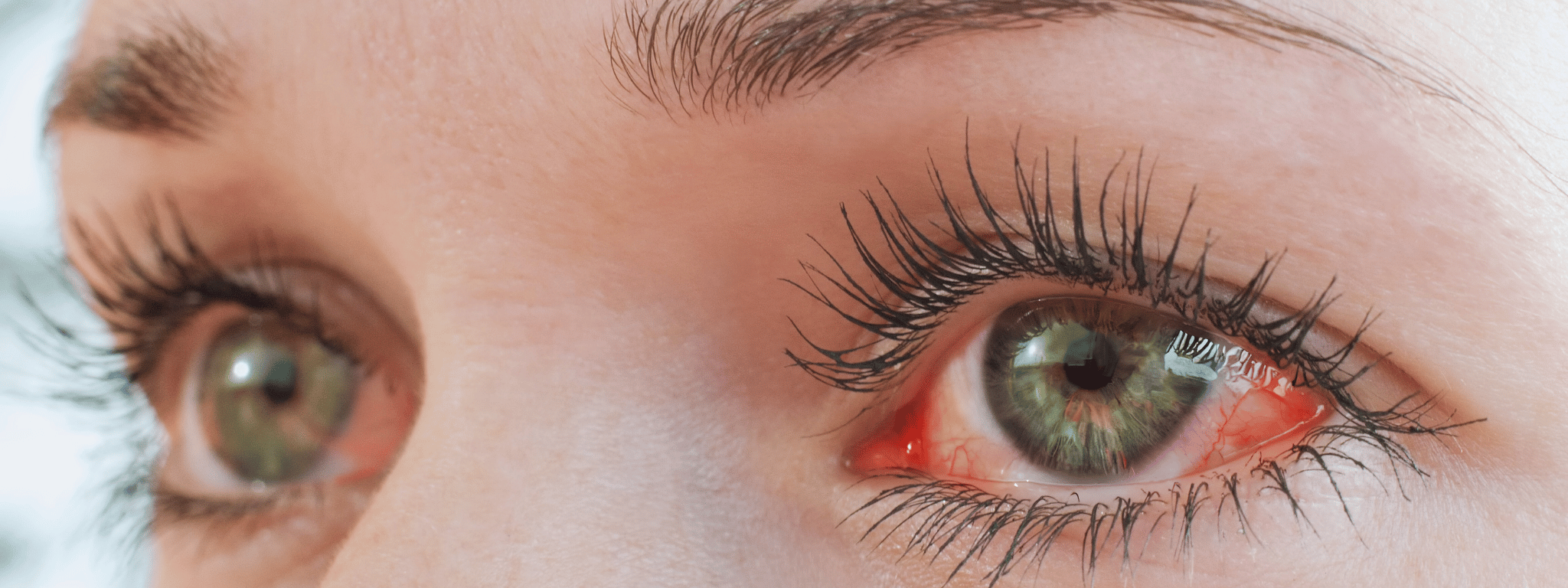 Come curare gli occhi rossi?